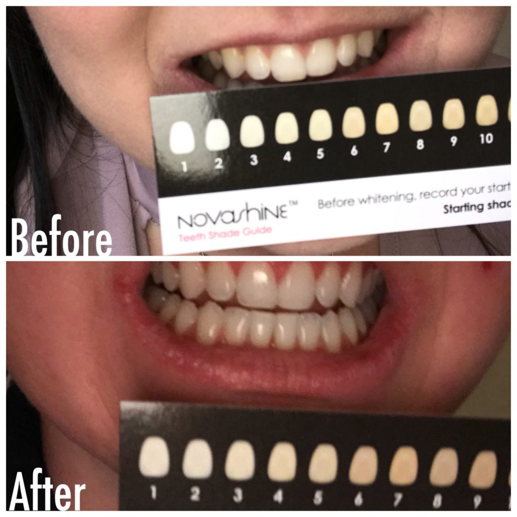Review NovaShine Teeth Whitening